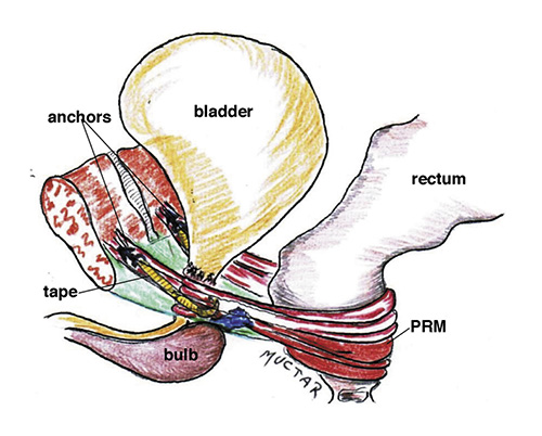  Site of the TFS sling. The tape is in the analogous position of PPL insertion in the removed prostate. The AdVance sling is somewhat lower, a mesh hammock placed at the anterior part of the bulb.