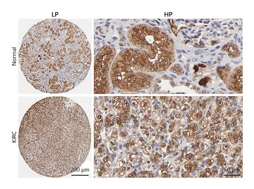 Fig. 4. The expression of BIRC5 protein of the normal and ccRCC kidney tissue in HPA (magnification: LP ×85; HP ×240). HPA, Human Protein Atlas; ccRCC, clear-cell renal cell carcinoma.