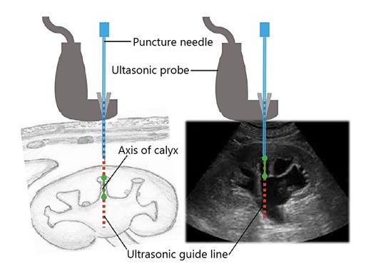 Fig. 1. The target calyx axis was used as the ultrasonic-guided marker to achieve percutaneous renal puncture. Schematic diagram in the left presents the needle entering the collecting system from the axis of the calyx along the ultrasonic guide line. Schematic diagram in the right displays the axis of the desired calyx on an ultrasonic image, and the ultrasonic guide line can assist the puncture needle to enter the collecting system from the axis of the desired calyx.