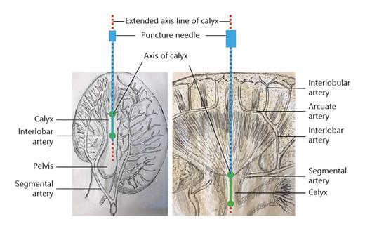Fig. 2. The relationship between vascular distribution and puncture route during PCNL. The diagram in the left is a cross-section of the kidney to illustrate the puncture through the axis of calyx can avoid renal vascular damage. The diagram in the right is a local enlargement of the renal pyramid and its peripheral vascular distribution, which shows the corresponding relationship between the renal pyramid and the calyx, and the puncture path through the axis of the calyx will minimize the damage to the vessels around the renal pyramid.