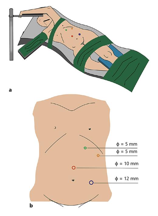 Fig. 1. Position (a) and port placement (b) in comprehensive modified laparoscopic pyeloplasty.