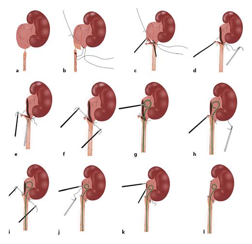Fig. 2. CMLP. UPJO, schematic diagram of trimming of the UPJ and renal pelvis (a); the first stitch was placed between the lower point of the spatulated ureter and the lowest corner of the renal pelvis (b); trimming of the renal pelvis (c); the posterior wall of the anastomosis formed using the touchless technique (d, e); placement of a ureteral stent (f); the anterior wall of the anastomosis formed using the touchless technique (g, h); trimming of the redundant renal pelvis (i); CMLP was completed (j, k). CMLP, comprehensive modified laparoscopic pyeloplasty; UPJO, ureteropelvic junction obstruction; UPJ, ureteropelvic junction.