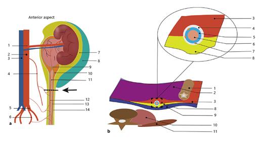 Fig. 3. Schematic diagram of the concept of membrane anatomy. a Diagram of a coronal cross section through the anatomical structure of the urinary system and the ureteric sheath (left kidney). 1, Renal arteries; 2, aorta; 3, vena cava; 4, ovarian/testicular arteries; 5, common iliac arteries; 6, internal iliac artery; 7, perirenal fat; 8, pararenal fat; 9, UPJ; 10, renal hilar fat; 11, ureter; 12, ureteral feeding vessel; 13, ureteric sheath. b Diagram of an axial cross section of the embryonic fascia or fusion fascia that surrounds and separates the ureter. Transverse sections are indicated by an arrow in a. 1, descending colon; 2, prerenal fusion fascia; 3, parietal peritoneum; 4, transversalis fascia; 5, posterior renal fascia; 6, ureter; 7, ureteric sheath; 8, psoas; 9, quadratus lumborum. UPJ, ureteropelvic junction.