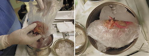  The graft kidney was wrapped in a plastic jacket filled with ice slush.
