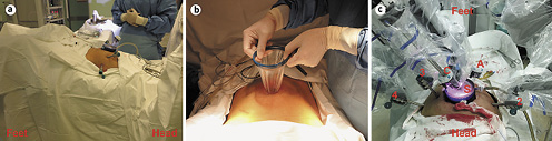  Patient position and trocar placement of RAKT. Lithotomy position with a 20° Trendelenburg tilt (a); a 5–6 cm periumbilical vertical incision for the single-port (b); Trocar placement with robot docking (c). S, single-port; C, 12-mm camera port; A, 12-mm assistant port; 2, 3, and 4, second, third, and fourth 8-mm robot arm ports.