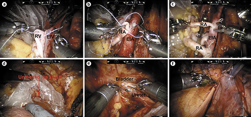  Procedure of RAKT. End-to-side continuous anastomosis of RV with EIV (a); End-to-side continuous anastomosis of RA with EIA (b); Double renal arteries were both anastomosed with EIA (c); The ice slush in the plastic jacket was not fully melted during rewarming time (d); Ureteroneocystostomy following the modified Lich-Gregoir technique (e); Extraperitonealization of the graft kidney (f). RV, renal vein; EIV, external iliac vein; RA, renal artery; EIA, external iliac artery.