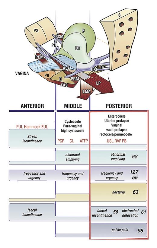 Fig. 1. Diagnostic algorithm. A “shorthand” diagnostic method where symptoms indicate which ligaments are causing which prolapse and which symptoms. The connective tissue structures fall naturally into 3 zones of causation. Ticking symptom occurrence diagnoses ligament defect and serves as a guide to surgery. For example, nocturia and pelvic pain are almost exclusively caused by “USL”; laxity; stress incontinence, by pubourethral laxity “PUL.” We have entered quantum of symptoms in numbers instead of ticking the boxes. The conditions in all 3 columns are caused by ligament laxity. Only some conditions in the right column can be attributed to IC, as defined [2]. Anterior zone runs from external meatus to bladder neck, and comprises EUL (external urethral ligament); PUL (pubourethral ligament); and suburethral vaginal hammock. Middle zone runs from bladder neck to anterior cervical ring and comprises PCF (pubocervical fascia); CL (cardinal ligament); and ATFP (arcus tendineus fascia pelvis). Posterior zone runs from USL (uterosacral ligament); RVF (rectovaginal fascia); to PB (perineal body). The height of the bar indicates probability of causation.
