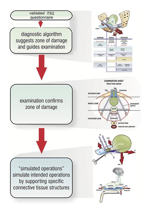 Fig. 2. Integral theory system diagnostic pathway-specific symptoms in the ITSQ questionnaire [8] indicate which ligaments/fascias may be damaged. The symptoms are transferred to the diagnostic algorithm; the diagnosis from the algorithm is checked by vaginal examination [6] to confirm specific ligament laxity; the causative ligaments are then checked by “simulated operations,” i.e., mechanical support of pubourethral and uterosacral ligaments to observe change in symptoms.