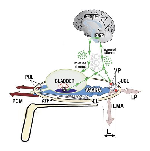 Fig. 3. “Simulated operation” to support uterosacral ligaments “USL.” 3D view of PUL and USL attachments to the pelvic brim (circle). A gently inserted speculum mechanically supports USLs. “L” indicates USL laxity. Lax USLs (laxity indicated by wavy lines) cannot support the “VPs” and these fire of impulses to the cortex which are interpreted as pain. Wavy lines in the muscles LP and LMA which contract against USLs indicate weakened muscle forces, as a muscle requires a firm insertion USL point to exert optimal force. The wavy form of the vagina indicates looseness; it cannot be stretched sufficiently to support the urothelial stretch receptors “N” which now fire off excess afferents to activate the micturition reflex prematurely. The cortex interprets these impulses as “urge.” The speculum mechanically supports USLs, “N” and stretches vagina to reverse the above processes; the patient reports lessening of pain and urge. LP, levator plate; LMA, conjoint longitudinal muscle of the anus.