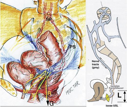 Fig. 4. Mechanism for CPP by stimulation of the VP. Left figure 3D view of organs and VP which serves as a type of “relay” for end organ afferents from bladder “B,” lower abdominal and pelvic muscles “M,” vagina/vulva “V,” rectum “R.” G = force of gravity which stimulates VP if they are not sufficiently supported by USLs. By permission S Muctar. Right figure 3D view showing pathways of impulses to and from the cortex (small arrows) via the hypogastric (Frankenhauser) plexus (T11-L2). And the effect of USL laxity “L.”