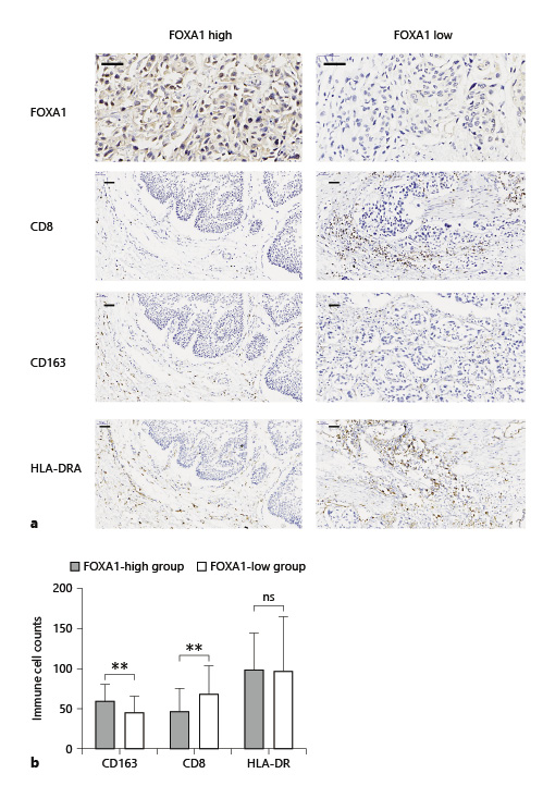  Comparison of infiltration of CTL, M2 TAM, and DC between FOXA1-low and FOXA1-high groups in bladder cancer. a Patients were divided into 2 groups by the FOXA1 expression level. High expression: intense staining of tumor cells (left panel) and low expression = no or faint staining of tumor cells (right). b FOXA1-low groups (right panel) showed significantly higher infiltration of CD8+ CTL, lower infiltration of CD163+ M2 TAM compared with the FOXA1-high groups (left panel). Scale bar, 50 μm. CTL, cytotoxic T lymphocyte; TAM, tumor-associated macrophage; DC, dendritic cell. **p < 0.01.