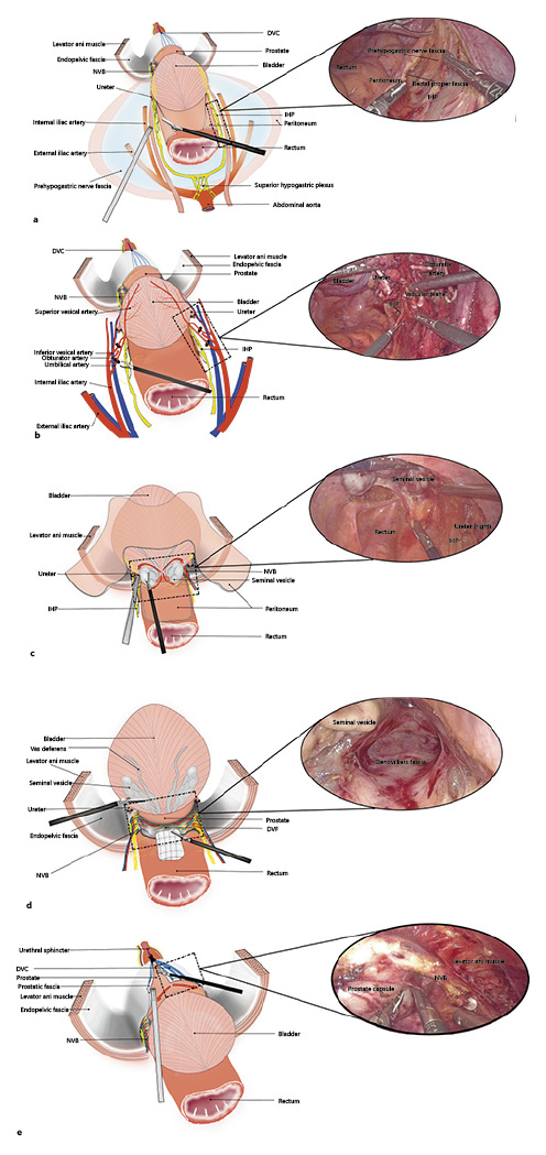  Surgical steps. Inferior hypogastric plexus dissection (a); Gaining control of the bladder pedicles (b); Autonomic nerve protection in the SV area (c); Maintaining the integrity of the DVF (d); Incision of the ventral prostatic fascia to perform intrafascial dissection (e). VD, vas deferens.