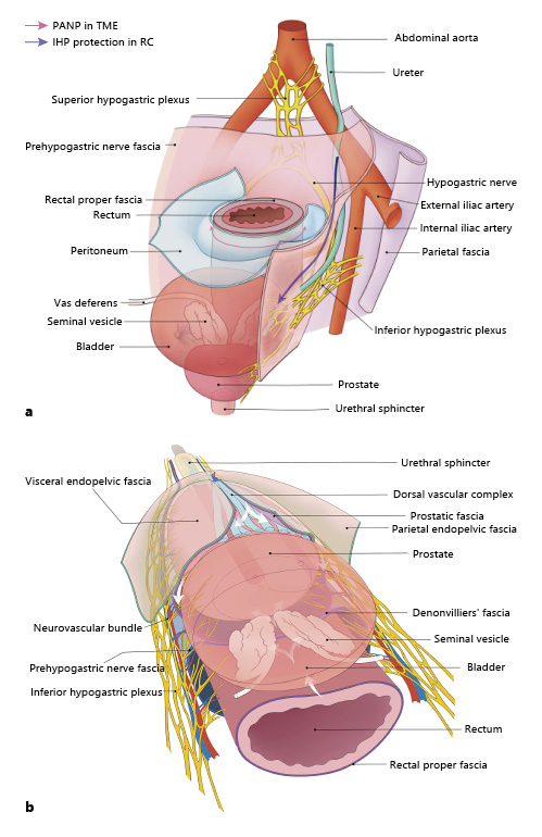  a The relationships among the ureter, pelvic autonomic nerve and fasciae. b Autonomic nerve dissection of the pelvic organs (the arrow indicates the line of dissection when performing nerve-sparing cystoprostatectomy). PANP, pelvic autonomic nerve preservation; TME, total mesorectal excision.