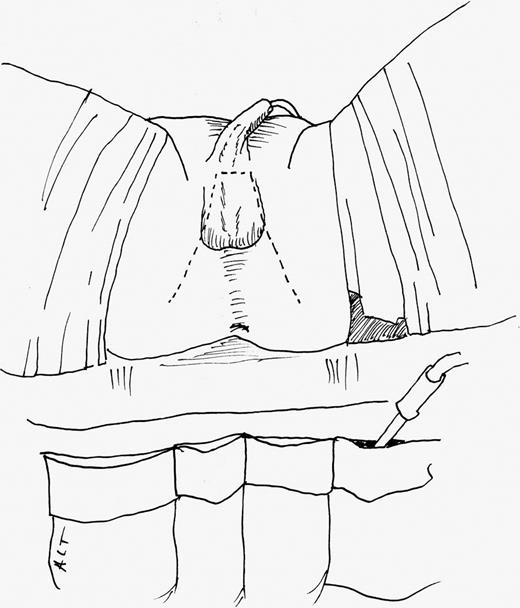 An inverted trapezoidal incision centered over the mid raphe is made in the perineum with the proximal aspect of the lateral incisions starting at the level of the ischial tuberosities. The distal aspect of the trapezoidal flap reaches up to the mid portion of the scrotum. Refer to the image caption for details.
