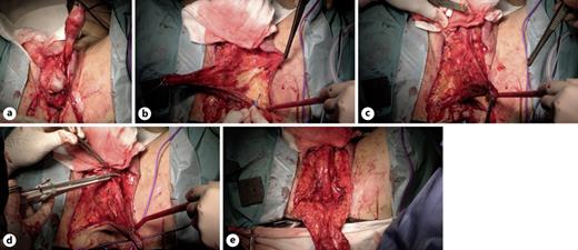 The testicles surrounded by the tunica vaginalis are completely freed and positioned temporarily over the lower abdomen (a). The newly formed flap has a wide trapezoidal perineal base and a wide rectangular shape along the scrotal raphe and includes dartos, subcutaneous tissue, and scrotal septum (b, c). The flap is elevated closely following the ventral aspect of the urethra starting at the penoscrotal angle and dissecting up to the central tendon of the perineum (d, e). Refer to the image caption for details.