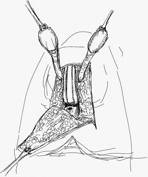 The mid-perineal scrotal flap (MPSF) incorporates all the subcutaneous tissue between the skin and the bulbar urethra. The testicles surrounded by the tunica vaginalis are completely freed and positioned temporarily over the lower abdomen. This approach allows a complete dissection of the proximal aspect of the urethra and exposure of the surgical plane between the rectum and the posterior aspect of the prostate. Refer to the image caption for details.