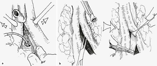 In case that a urethral stricture is associated with the fistula, an anastomotic urethroplasty is performed, either bulbo-prostatic or urethro-vesical in case that the patient had previously undergone a radical prostatectomy. Stepwise maneuvers of the elaborated perineal posterior urethroplasty may be used as necessary to achieve a tension-free anastomosis. The urethra is transected at the point of the fistula and mobilized distally beyond the crus as far as the penoscrotal junction. Then corporeal body separation in bloodless plane is performed from the crus distally for 3–5 cm (a). If after corporal body separation, and inferior wedge pubectomy, a tension-free anastomosis cannot be achieved, the urethra is routed around the lateral side of the left corporal body. A small furrow of the bone should be gouged from the left ischiopubic ramus where the urethra runs, to avoid its compression between the corpus and bone (b). Refer to the image caption for details.
