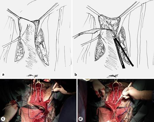 To avoid recurrence of the fistula, the distal aspect of the MPSF is de-epithelialized and used as interposition flap. De-epithelialization can be done with scalpel or scissors and care should be taken to avoid damage of the subcutaneous vascularization (a–d). Refer to the image caption for details.