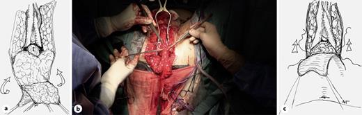 The fistulous tract is resected, the borders of the rectal orifice refreshed and closed with a single or double layer of absorbable stitches (a). The distal aspect of the de-epithelialized MPSF is fixed with 3 or 4 stitches to the anterior rectal wall, proximally to the location of the fistula to provide complete coverage of the rectal suture. The elasticity of the fat tissue allows the flap to adapt well and efficiently to the space created between the rectum and the prostate (b, c). Refer to the image caption for details.