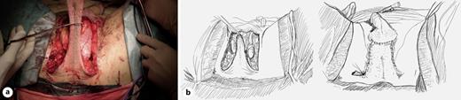 The distal skin of the flap devoted of subcutaneous fat tissue is resected (a). A drain is left, the testicles are repositioned to its original position, and the skin is closed. The remnant scrotal skin has enough elasticity to allow a tension-free closure of the scrotal skin (b). Refer to the image caption for details.