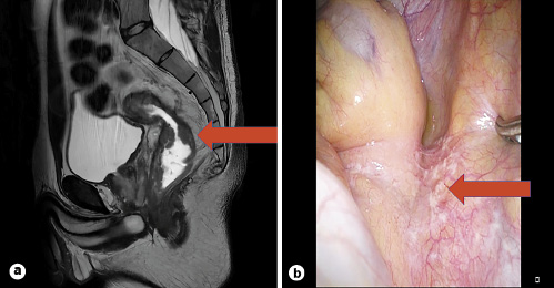 Illustration of the clinical findings of rectal cancer. a MRI scan of the pelvis. b Laparoscopic protective ileostomy surgery revealing peritoneal carcinosis.