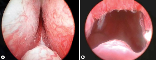  An endoscopic view of the prostatic urethra before and 6 months after implementation of the Butterfly.