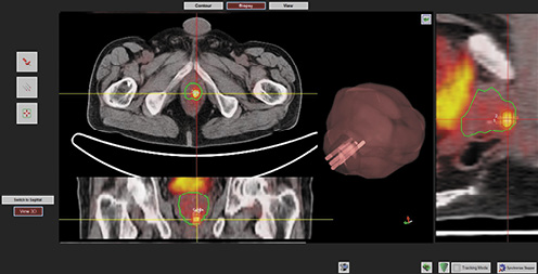  Software fusion biopsy of the ROI delineating the lesion positive at 68Ga-PSMA PET/CT; the green line delineates the prostate gland and the red line the contoured target lesion. The number of cores and their corresponding tumor sampling are defined in the three-dimensional volume-rendering panel. Refer to the image caption for details.