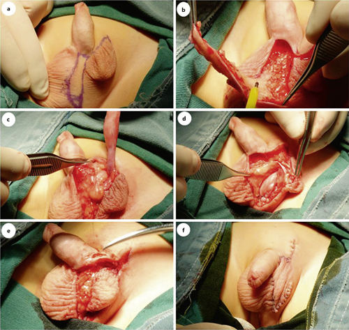 Surgical procedure: designed the incision (a); resected the intervening longitudinal skin (b); separated the spermatic cord (c); fixed the testis (d); rotated the flap (e); and sutured the scrotum (f).