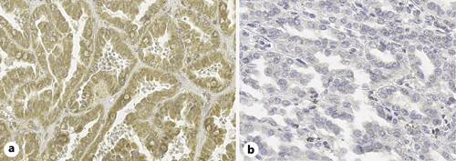Immunohistochemical staining of Gas 6 in pRCC specimen. a Positive (×40 magnification). b Negative (×40 magnification).