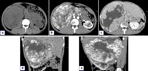 Preoperative CT and intraoperative imaging examination. a Plain scan showed a heterogeneous mass about 175 × 130 mm in size on the right kidney, with multiple low-density shadows and nodular calcification. b Significant enhancement of the arterial mass. c The mass density is relatively low compared with the parenchyma of the venous stage. d Coronal mass. e A mass on the sagittal plane. CT, computed tomography.