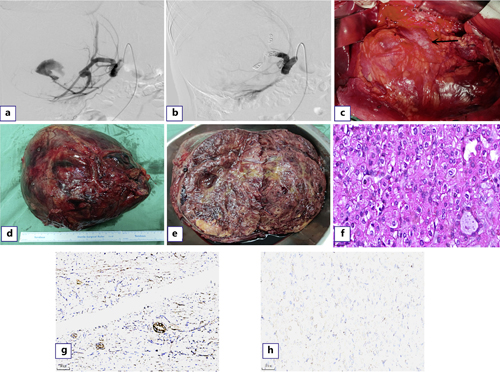 Arteriography: (a) before embolization of the main and branch of the right renal artery; (b) After embolization of the main and branch of the right renal artery. Intraoperative landscape: (c) intraoperative mass and severe adhesion of inferior vena cava (arrow indicates inferior vena cava). Gross specimen: (d) complete tumor capsule can be seen by naked eye; (e) the inside of the tumor is gray yellow, gray red, soft, partially translucent, and the kidney is severely squeezed to the side. HE staining: (f) tumor cells were distributed in glandular or solid form, with eosinophilic cytoplasm, oval or polygonal karyotype, fine chromatin, low ISUP grading, and unclear nucleoli (×400). Immunohistochemistry: (g) positive expression of SDHB antibody in the remaining renal tubules (×200); (h) absence of SDHB expression in tumor cells (×200). Refer to the image caption for details.