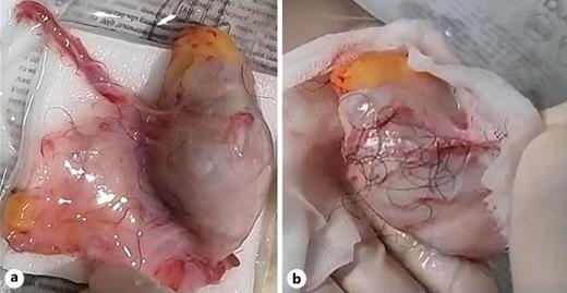 Initial amputated testes on both sides in the emergency room. a Right testis with remnant skin. b Left testis.