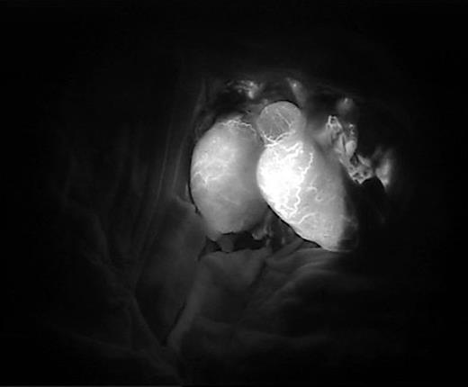 Immediate post-anastomosis indocyanine findings of both testes. Viability of the testes was confirmed.