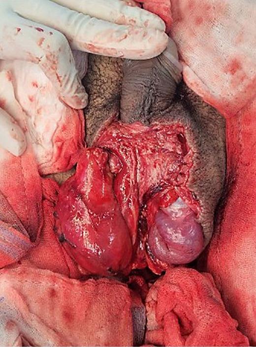 Immediate postoperative findings after replantation and insetting of both testes.