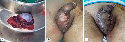 a Self-amputated right testis with congestion. Right testis was decided to remove. b Immediate postoperative findings after composite skin graft. c Postoperative day (POD) 9 findings. The patient was discharged without any skin complication.
