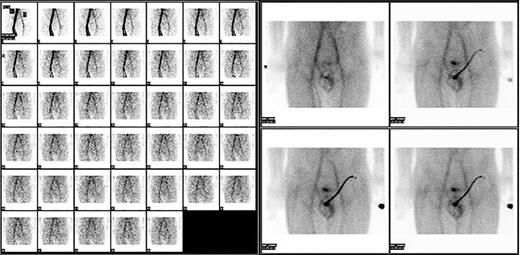 Testicular scan of the patient showing the viability of the testis. Blood pool activity and perfusion increased compared with normal levels on the left testis.