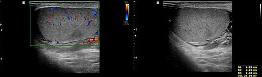Doppler ultrasonography of the patient. No other abnormality except mild fluid collection was shown on the left testis and epididymis.