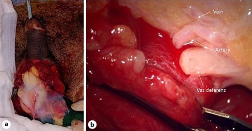 a Preoperative finding of the puboscrotal area with both testes amputated. b Detected testicular vessels and the vas deferens before anastomosis. Refer to the image caption for details.