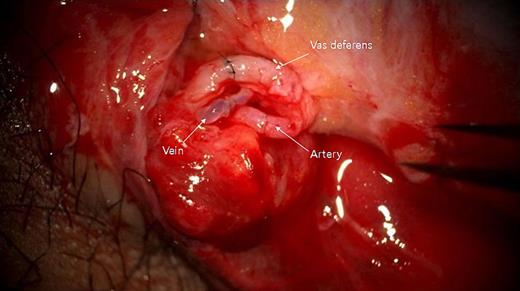 Immediate post-anastomosis findings of the right testis. Upper: vas deferens; middle: testicular vein; lower: testicular artery. Refer to the image caption for details.