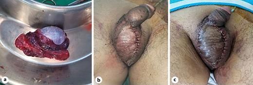 a Self-amputated right testis with congestion. Right testis was decided to remove. b Immediate postoperative findings after composite skin graft. c Postoperative day (POD) 9 findings. The patient was discharged without any skin complication. Refer to the image caption for details.