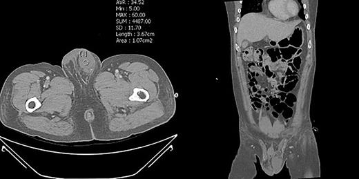 Enhanced abdominal pelvis CT of the patient. The left testis of the left scrotum revealed patent with showing vascularity. Refer to the image caption for details.