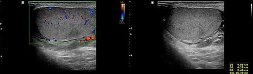 Doppler ultrasonography of the patient. No other abnormality except mild fluid collection was shown on the left testis and epididymis. Refer to the image caption for details.