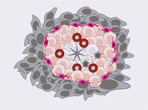 Cellular composition of TLSs. The intermediate B cells are surrounded by T cells, and there are characteristic high endothelial vesicles in them. Fibroblast reticulocytes settle at the junction of tumor and T cells, while dendritic cells and follicular dendritic cells are scattered among them.