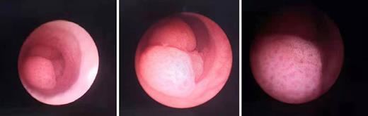 Three cauliflower-like neoplasms were found in the left proximal ureter. Refer to the image caption for details.