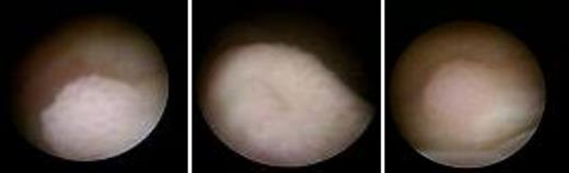 A cauliflower-like neoplasm was found 1 cm away from the left ureteral orifice in the bladder.