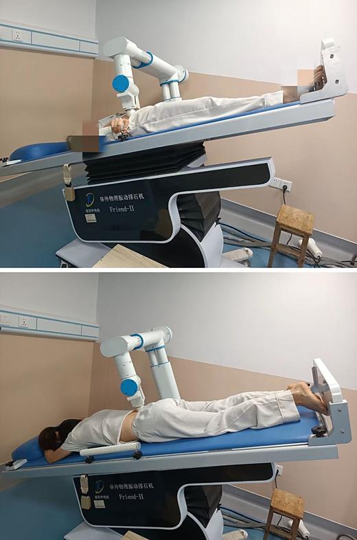 The figure above shows a patient with lower calyceal RF undergoing EVPL after ureteroscopic surgery. Refer to the image caption for details.