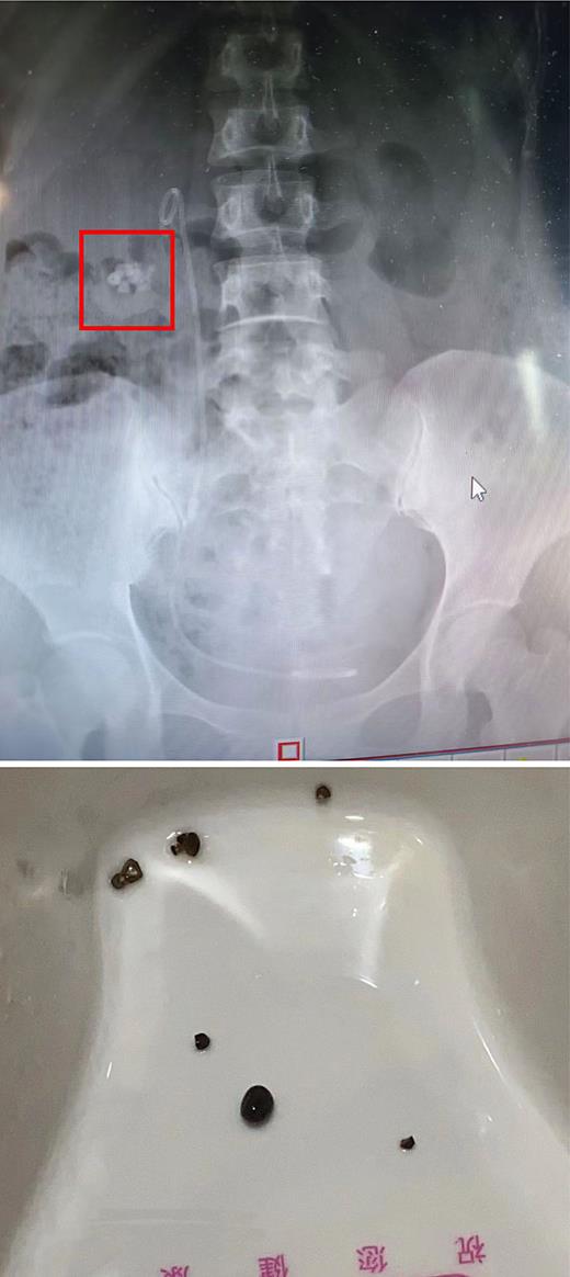 The image above shows the RF position of the urinary tract radiograph; the image below shows RF excreted in urine after four EPVL sessions.
