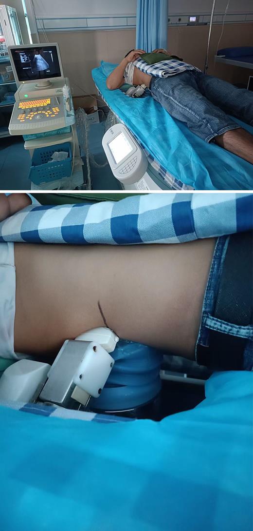 The figure above shows EVPL being performed in a patient with a 6 mm stone in the lower ureter (inner part of the bladder wall).