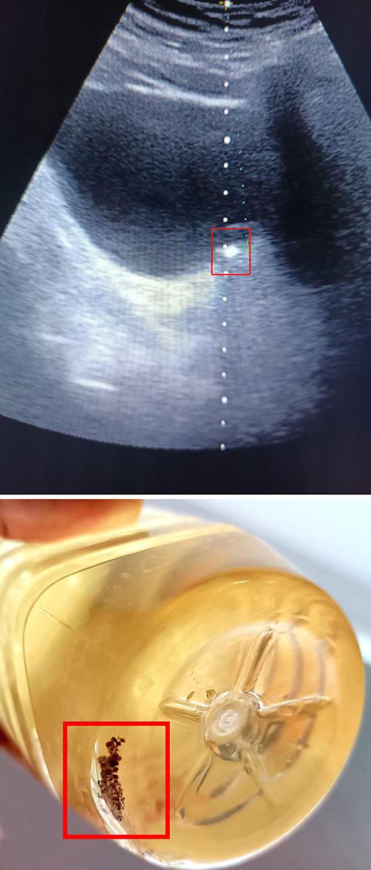 The image above is the stone under ultrasound localization; the image below is a stone passed in the urine after EVPL. Refer to the image caption for details.