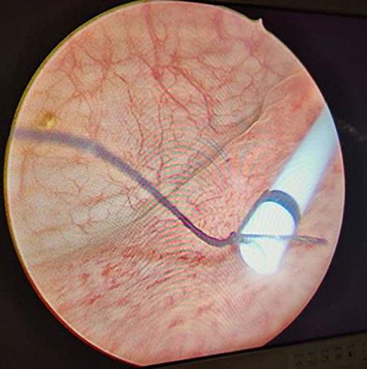 Suture (5-0 mersilk) tied to the distal end of ureteral stent.